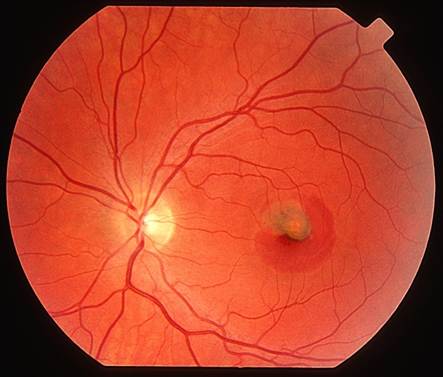 Presumed Ocular Histoplasmosis Syndrome Retina Image Bank